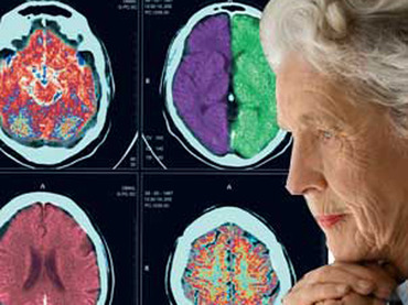 Estudios sobre el Alzheimer